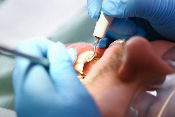 Best Chipped Tooth Repair Near Me  in Chester, PA